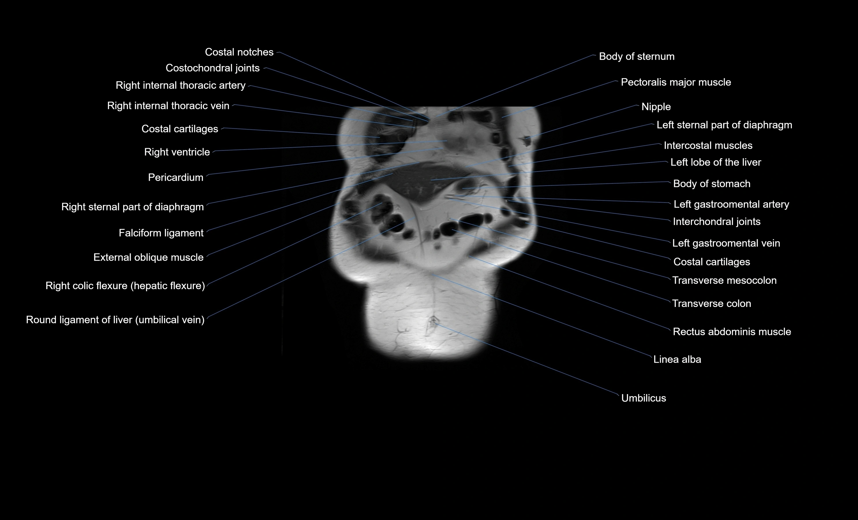 MRI Abdomen coronal labelled cross sectional anatomy radiology  image-img-00001-00009.webp